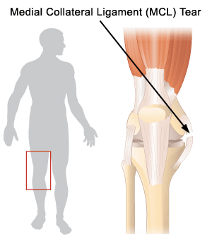 What are Medial Collateral Ligament (MCL) Tears & How to Recover