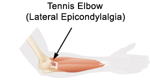 tenniselbow.gif