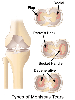 meniscus.gif