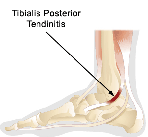 Posterior Tibial Tendonitis Chappell Physical Therapy Llc