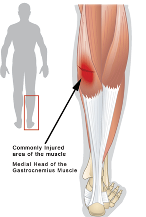 Calf Muscle Strain :: Chappell Physical Therapy, LLC