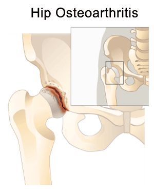 hiposteoarthritis.gif