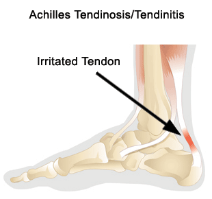 Achilles Tendon Injuries :: Chappell Physical Therapy, LLC