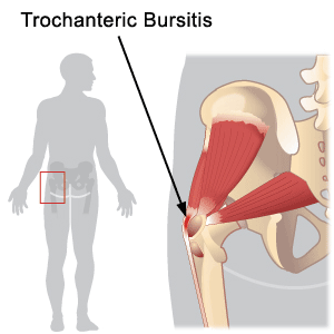 trochantericbursitis.gif