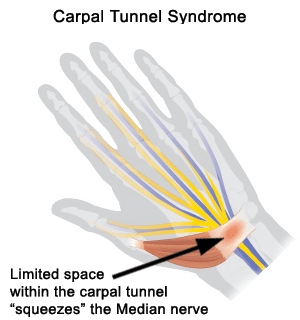 carpal tunnel.gif