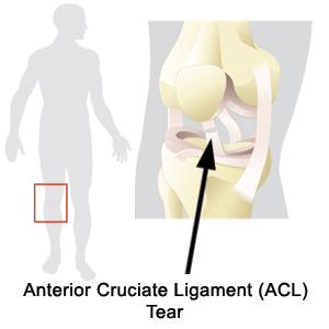 acl.gif